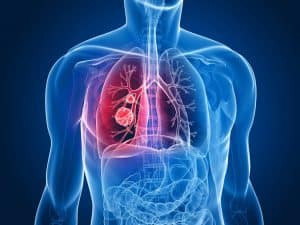 Norland Micro Oligopeptide Treats Cancer Of The Lungs